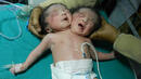 Бруталният случай на сиамските близнаци с две глави и едно тяло (СНИМКИ)