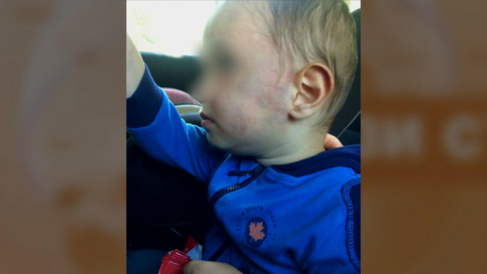 2 годишно дете беше взето от детска градина със синини по