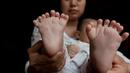 В Китай се роди момченце с 31 пръста
