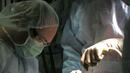 Рекордно разширена коремна аорта оперираха в Бургас