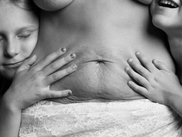 Удивителни снимки показват белезите на жени след раждане