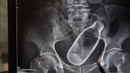 Шокираща интервенция: Доктори извадиха нещо страшно от тялото на мъж (ВИДЕО)