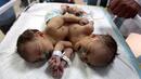 Здраво бебе с две глави се роди в Бангладеш