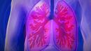 Рак на белите дробове: Три необичайни признака