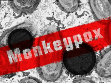 Случай на маймунска вариола e потвърден в София