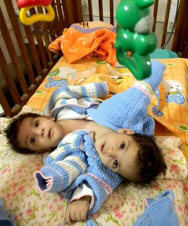 Разделиха 11-месечни сиамски близначета

