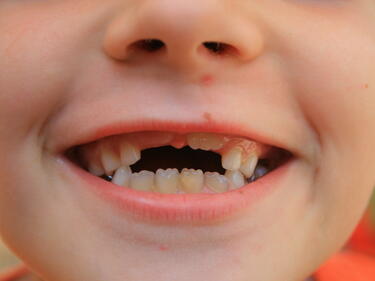 В Сливенско правят кампания за силанизиране на детските зъби 