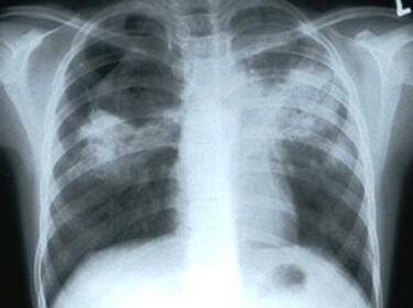 Туберкулоза плъзна в Северозападна България