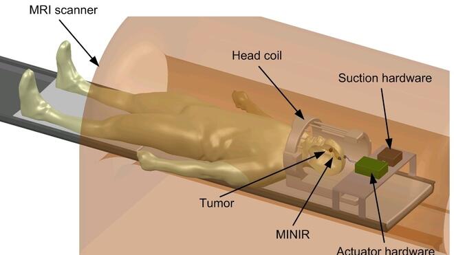 С MINIR хирурзите ще извършват сложни мозъчни операции по отстраняване на тумори директно докато пациентът е в тръбата на магнитно-резонансния томограф