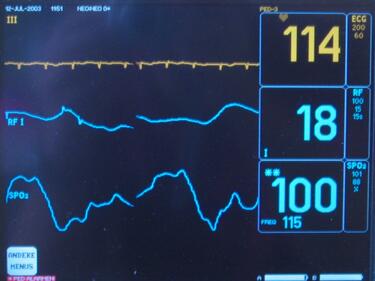 Пациент открадна електрокардиограф от спешен център