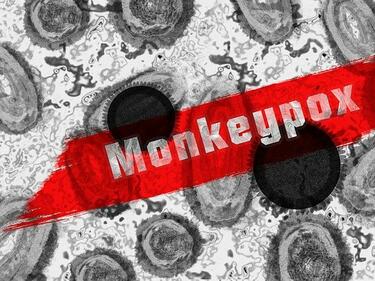 Какво е състоянието на заболелите от маймунска шарка
