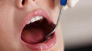 Защо е важно редовно да почистваме зъбния камък?